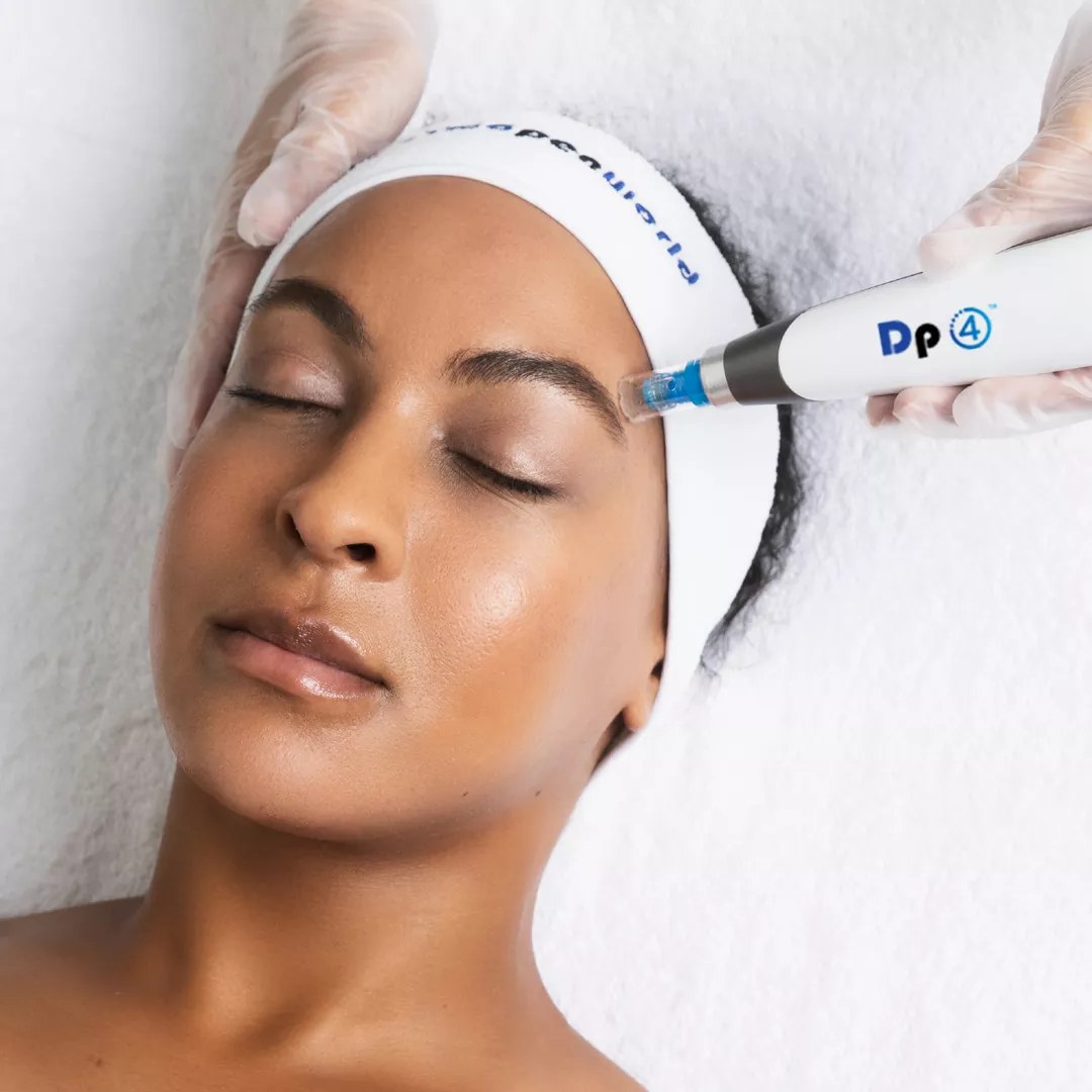 Microneedling with Exosomes